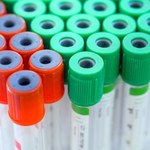 Siedem powodów dla których warto oznaczyć poziom kwasu moczowego. Wskaże przyczynę problemów
