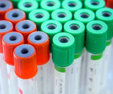 Siedem powodów dla których warto oznaczyć poziom kwasu moczowego. Wskaże przyczynę problemów