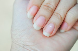Skąd białe przebarwienia na paznokciach?  