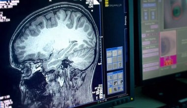 Skan mózgu dziecka ujawnia ryzyko zaburzeń. Niezwykłe odkrycie w neuronauce