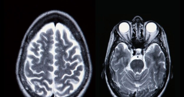 Skany mózgu mogą wskazać dysfunkcje połączeń nerwowych /123RF/PICSEL