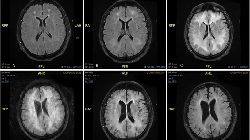 Skany MRI pacjenta pokazują stopniową degenerację substancji białej w mózgu /materiały prasowe