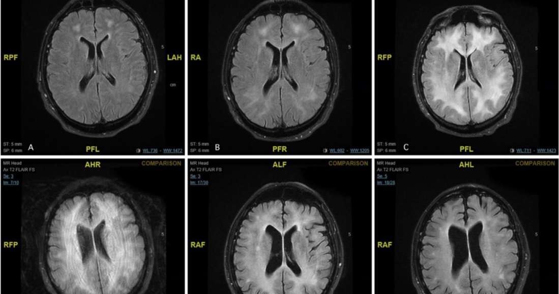 Skany MRI pacjenta pokazują stopniową degenerację substancji białej w mózgu /materiały prasowe