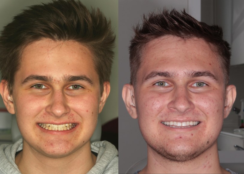 Skazą na równych zębach Mateusza były białe plamy - odwapnienia po aparacie /Polsat Cafe