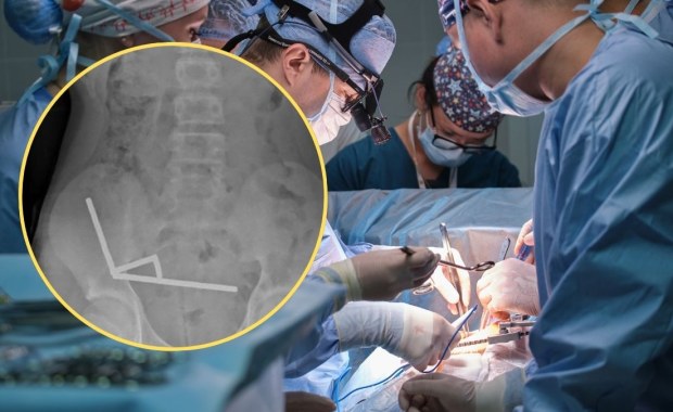 Skończyło się operacją. Nie uwierzysz, co nastolatek miał w jelicie