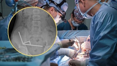 Skończyło się operacją. Nie uwierzysz, co nastolatek miał w jelicie