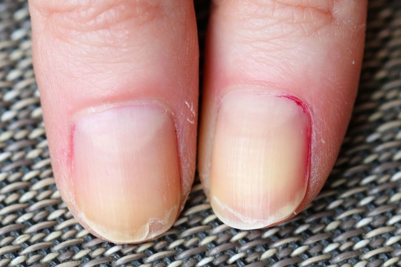 Słabe, łamiące się paznokcie mogą być objawem niedoboru magnezu /123RF/PICSEL