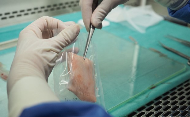 Śląsk: Kolejny szpital będzie przekazywał owodnię do Centrum Leczenia Oparzeń 