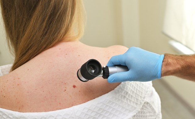Specjaliści biją na alarm. Dynamiczny wzrost zachorowań na czerniaka