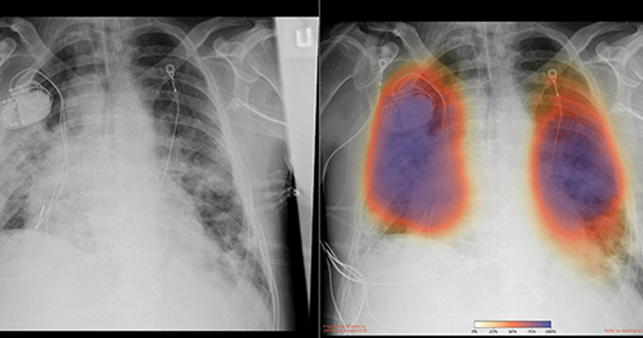 Specjaliści próbują wykorzystywać gromadzone na różne sposoby dane do uczenia modeli wykrywających najważniejsze symptomy wirusa, wspierających stawianie diagnoz, prognozujących, jak wirus będzie się rozwijał /University of California San Die/Ferrari Press/East News /East News