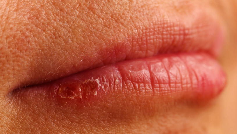 Stan zapalny w okolicy ust może mieć kilka różnych przyczyn /123RF/PICSEL