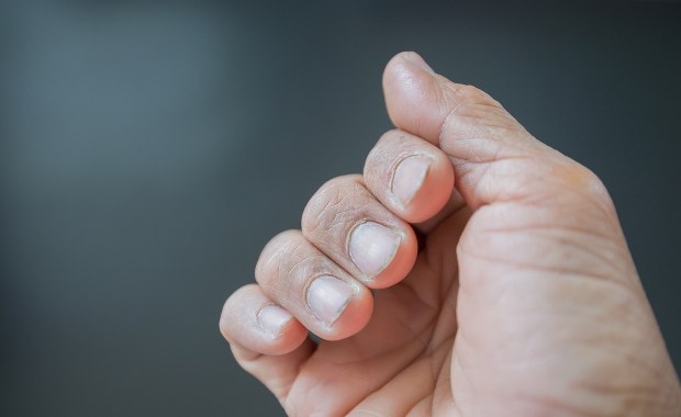 Stan zdrowia zapisany na paznokciach? To sygnały, które lepiej skonsultować z lekarzem