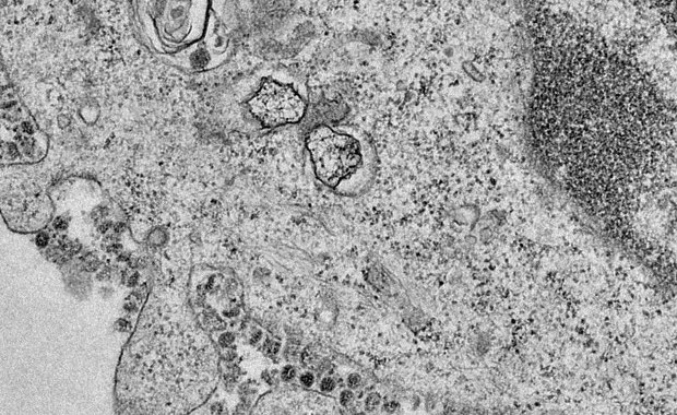 Sterydy mogą nie pomóc w leczeniu. Nowe fakty na temat koronawirusa