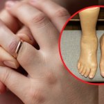 Stopy lub dłonie puchną do monstrualnych rozmiarów. Czym są obrzęki limfatyczne?