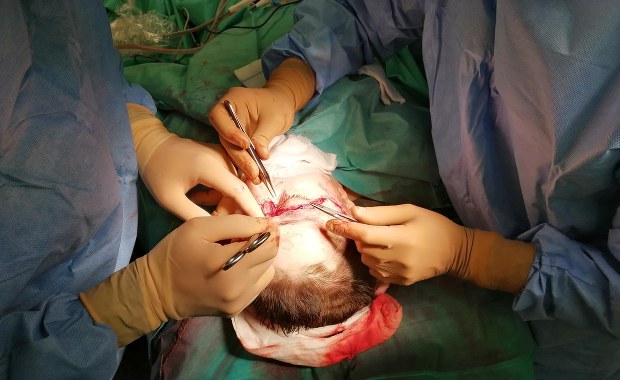 Straciła w pracy skalp. Przyszyli go chirurdzy z Gliwic