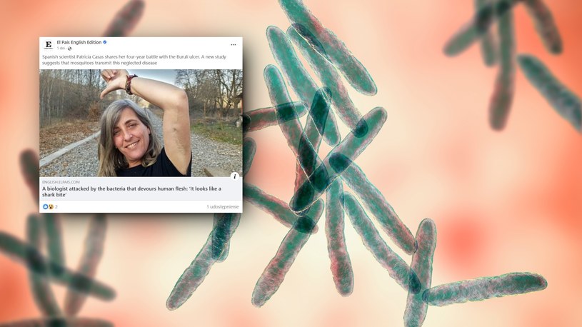 Straszna bakteria zaatakowała biolożkę. Kobieta musiała przejść cztery operacje i zrezygnować z kariery naukowej /123RF/Facebook/El Pais /123RF/PICSEL