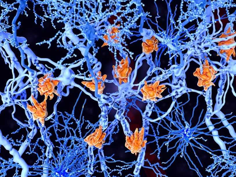 Stwardnienie rozsiane to choroba demielinizacyjna, w której uszkodzeniu ulegają osłonki komórek nerwowych. SM jest chorobą autoimmunologiczną - komórki mikrogleju (pomarańczowe) atakują oligodendrocyty (glejowe), które tworzą izolacyjną osłonkę mielinową wokół aksonów neuronów