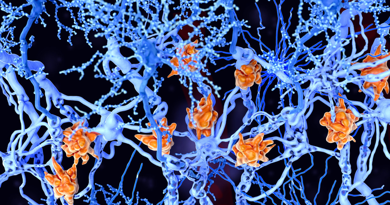 Stwardnienie rozsiane to choroba demielinizacyjna, w której uszkodzeniu ulegają osłonki komórek nerwowych. SM jest chorobą autoimmunologiczną - komórki mikrogleju (pomarańczowe) atakują oligodendrocyty (glejowe), które tworzą izolacyjną osłonkę mielinową wokół aksonów neuronów