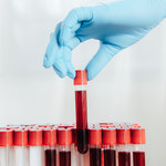 Stworzono test krwi, który wykryje raka lata przed właściwą chorobą