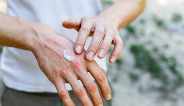 Sucha skóra na dłoniach. Przyczyny i zapobieganie 