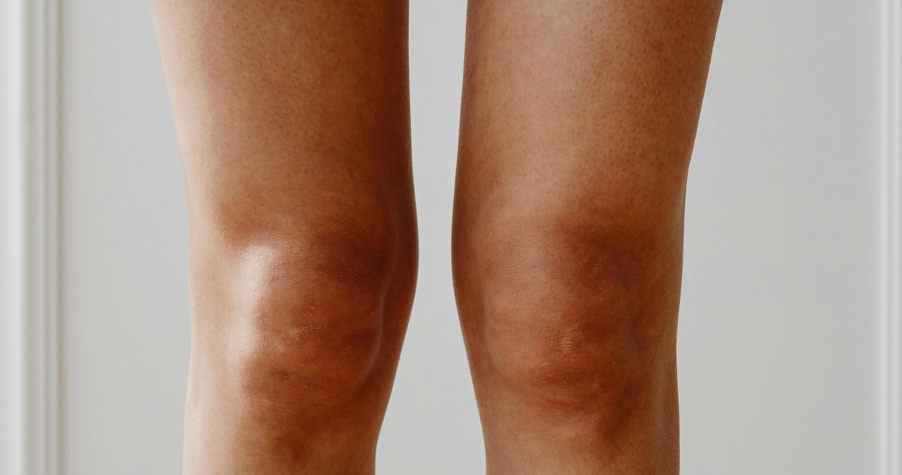 Sucha skóra na nogach to jeden z najczęstszych problemów zimą /Karola G /pexels.com