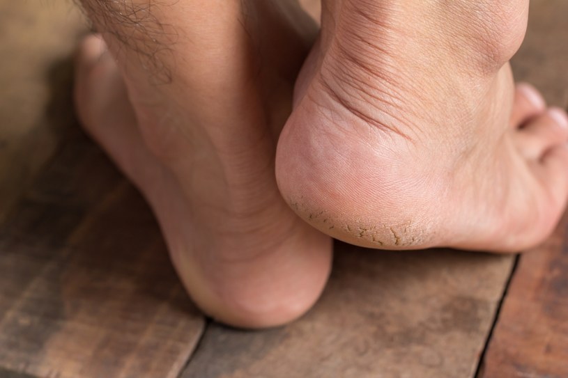 Sucha, swędząca skóra może świadczyć o grzybicy stóp /123RF/PICSEL