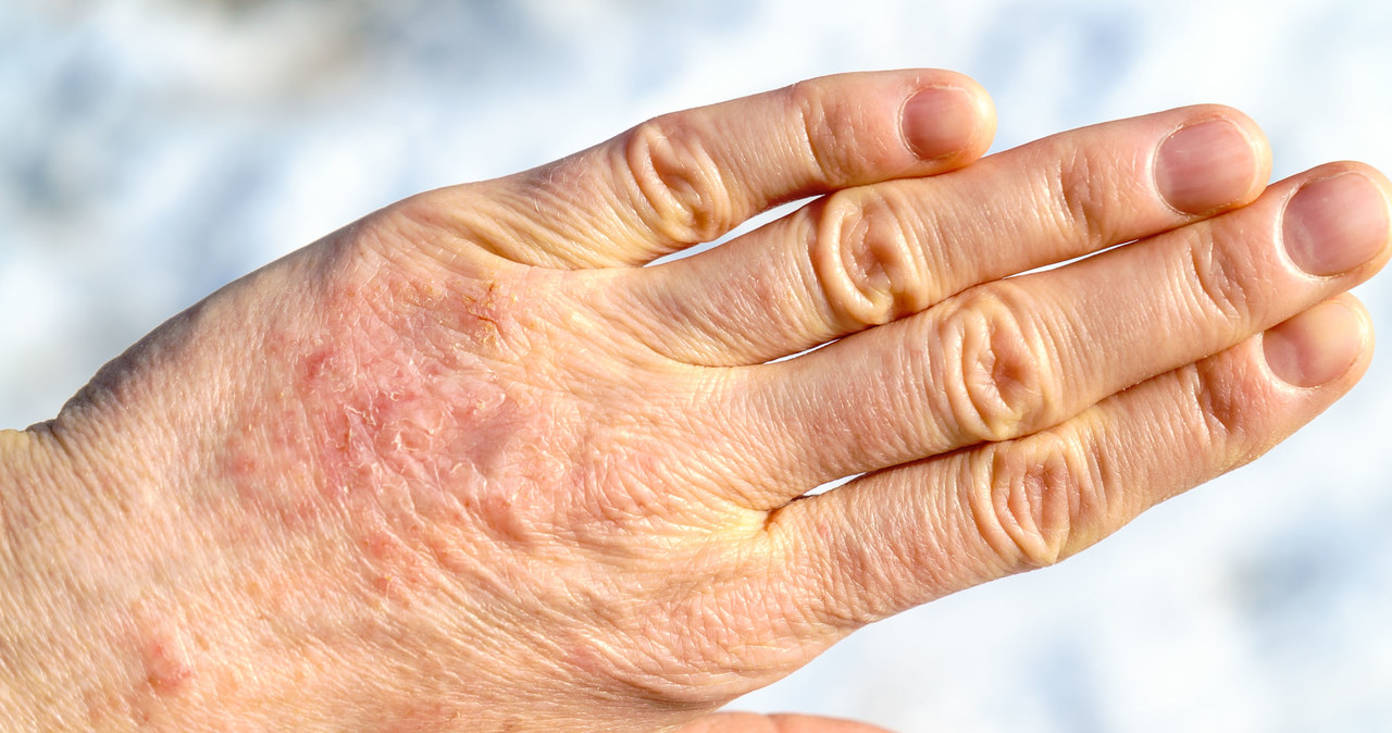 Mãos secas com tendência a rachaduras podem ser um sintoma de doença ou deficiência de vitaminas/123RF/PICSEL