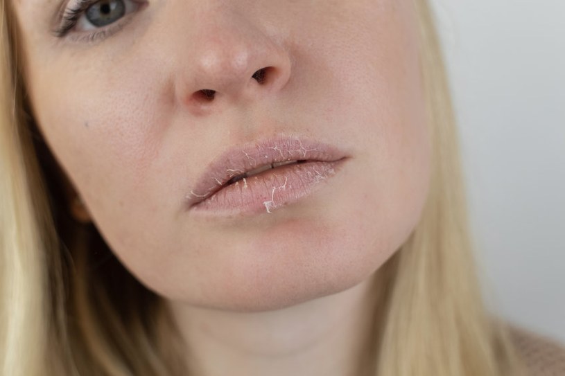 Suche i popękane usta dają się we znaki? Prosty domowy sposób na wygładzenie i nawilżenie