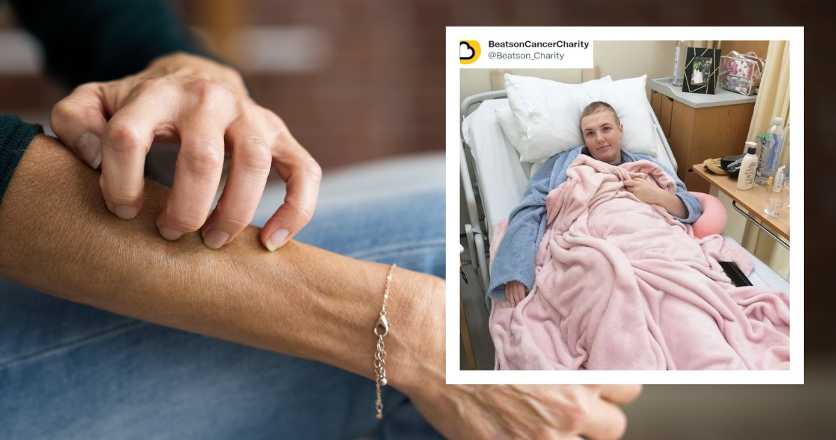 Swędzenie skóry to często bagatelizowany objaw. U 30-latki był sygnałem rozwijającego się nowotworu /123RF/PICSEL & BeatsonCancerCharity/ Twitter /