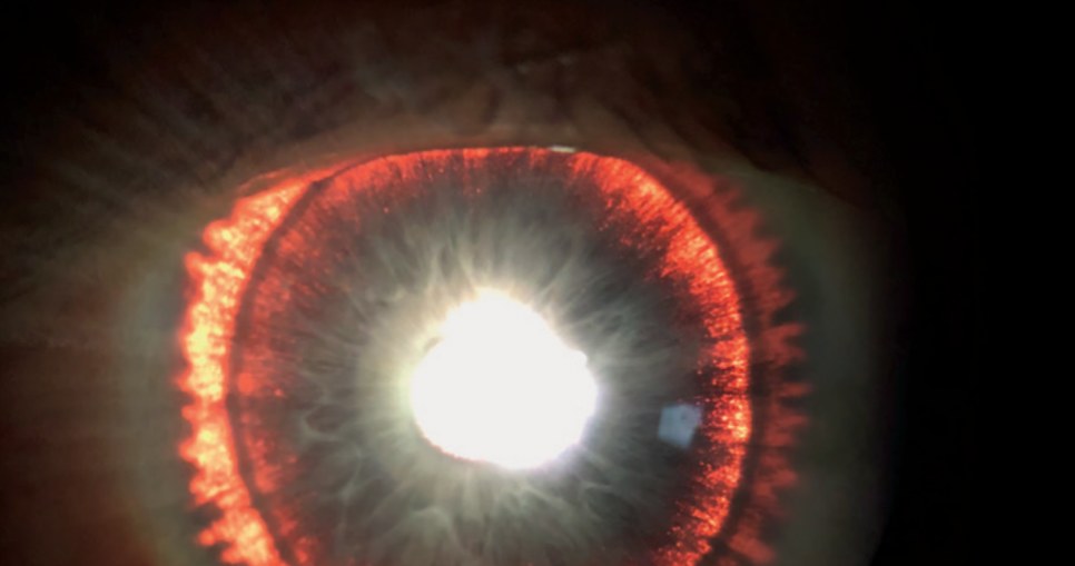 Świecące tęczówki to objaw rzadkiej choroby oczu /materiały prasowe