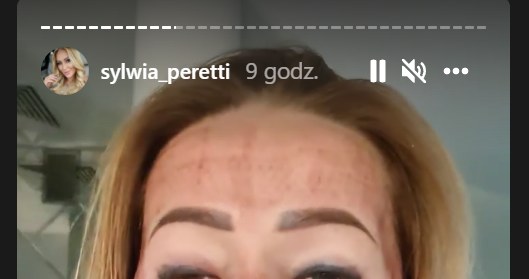 Sylwia Peretti pokazała zdjęcia po zabiegu laserowym/ źródło: https://www.instagram.com/sylwia_peretti/?hl=pl /Instagram /Instagram