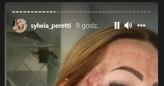 Sylwia Peretti pokazała zdjęcia po zabiegu laserowym/ źródło: https://www.instagram.com/sylwia_peretti/?hl=p /Instagram /Instagram