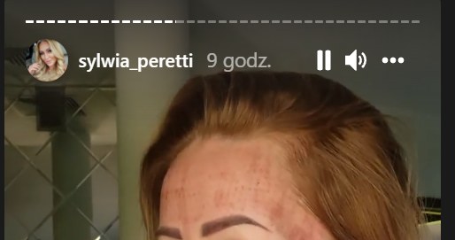 Sylwia Peretti pokazała zdjęcia po zabiegu laserowym/ źródło: https://www.instagram.com/sylwia_peretti/?hl=p /Instagram /Instagram