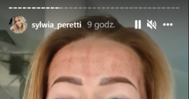 Sylwia Peretti pokazała zdjęcia po zabiegu laserowym/ źródło: https://www.instagram.com/sylwia_peretti/?hl=p  Czytaj więcej na https://pomponik.pl/plotki/news-sylwia-peretti-pokazuje-poparzona-twarz-drastyczne-zdjecia,nId,5575533#utm_source=paste&utm_medium=paste&utm_campaign=chrome