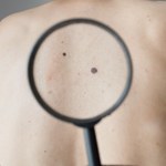 Szczepionka przeciw HPV skuteczna w leczeniu raka skóry