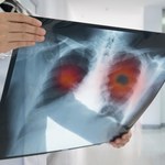 Szczepionka przeciwko rakowi płuc? Pracują nad nią brytyjscy naukowcy