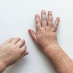 szkarlatyna Szkarlatyna w Ameryce przed Kolumbem? Przełomowe odkrycie w mumii