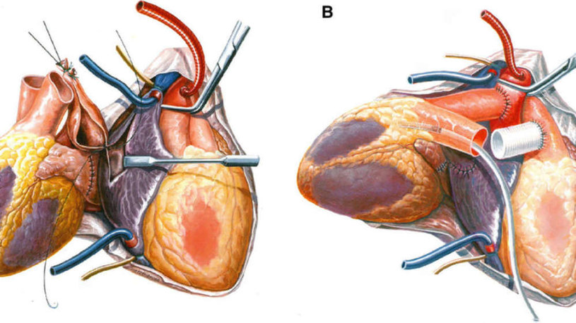 Szkic ilustrujący transplantację heterotopową /materiały prasowe