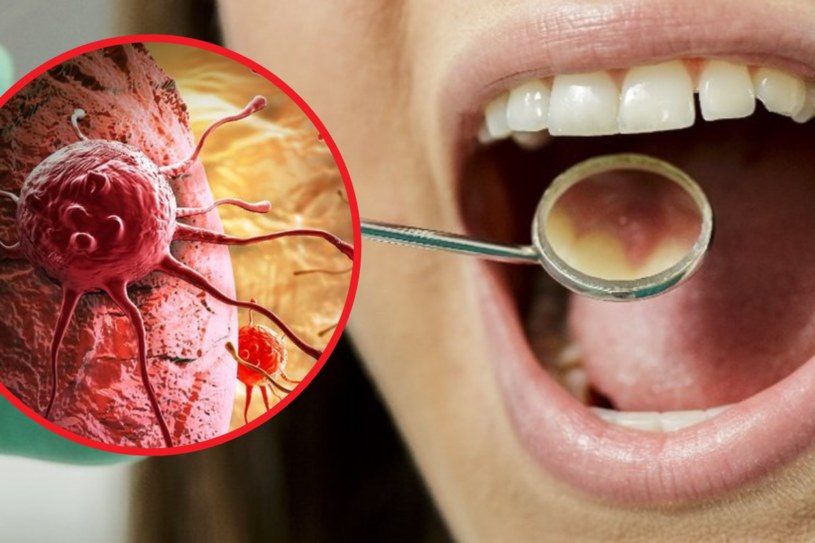 Szkliwiak najczęściej rozwija się w żuchwie w pobliżu zębów trzonowych. Ból jest objawem nietypowym /123RF/PICSEL