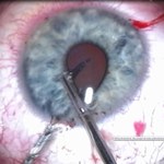 Szkło w oku dziecka. Zobacz niezwykłe nagrania z operacji!