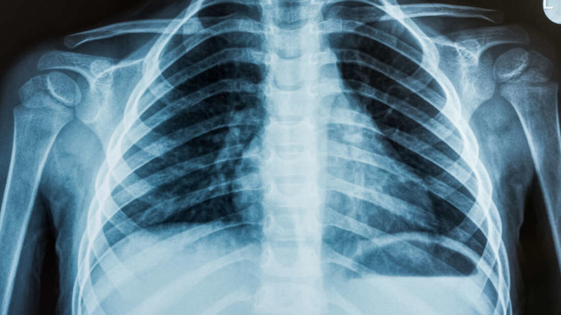 Sztuczna inteligencja na podstawie zdjęcia rentgenowskiego płuc potrafi wskazać rasę człowieka. I nikt nie wie, jak to robi /foto: Lancet Digital Health /domena publiczna