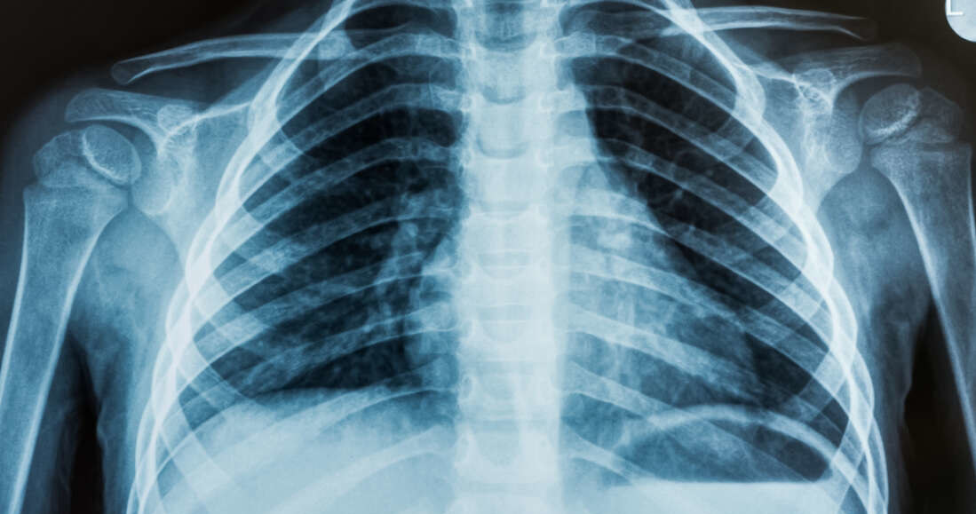 Sztuczna inteligencja na podstawie zdjęcia rentgenowskiego płuc potrafi wskazać rasę człowieka. I nikt nie wie, jak to robi /foto: Lancet Digital Health /domena publiczna