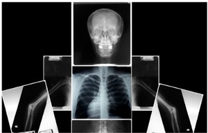 Sztuczna inteligencja odczytała rasę człowieka ze zdjęć rentgenowskich