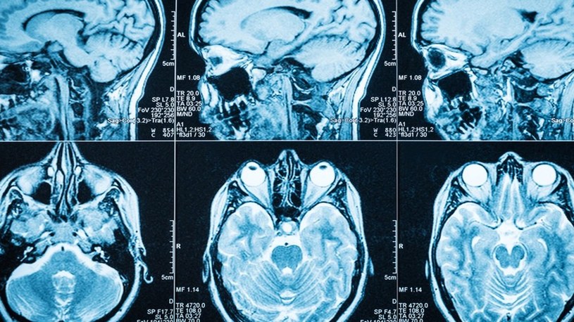 Sztuczna inteligencja szybko wykryje u Was objawy zbliżającego się Alzheimera /Geekweek