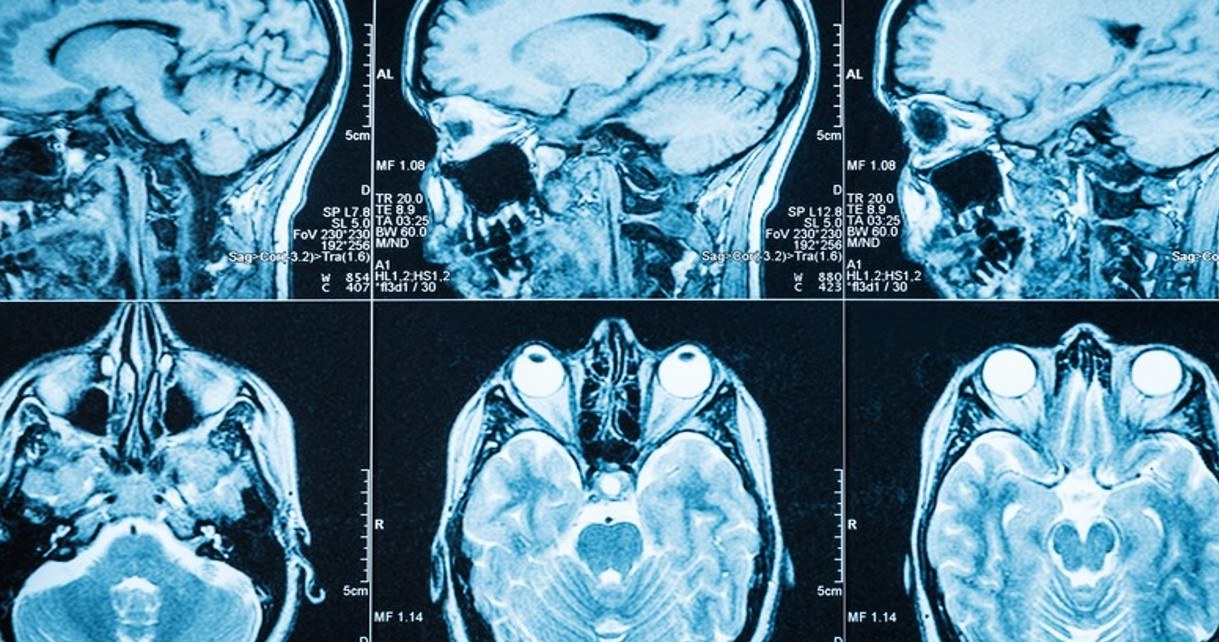 Sztuczna inteligencja szybko wykryje u Was objawy zbliżającego się Alzheimera /Geekweek