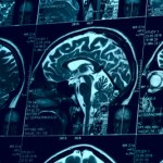 Szybki test nową nadzieją na wczesne wykrycie choroby Alzheimera