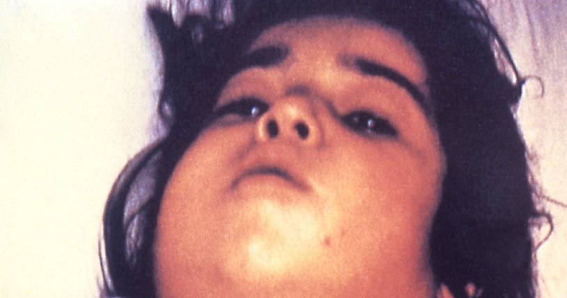"Szyja Nerona" - obrzęk szyi będący następstwem błonicy. Fot. CDC /Wikipedia