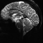Ta choroba mózgu przeraziła Kanadę. Oni twierdzą, że… nie istnieje