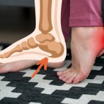 Tak objawia się ostroga piętowa. Domowe sposoby na bolesne złogi w stopie