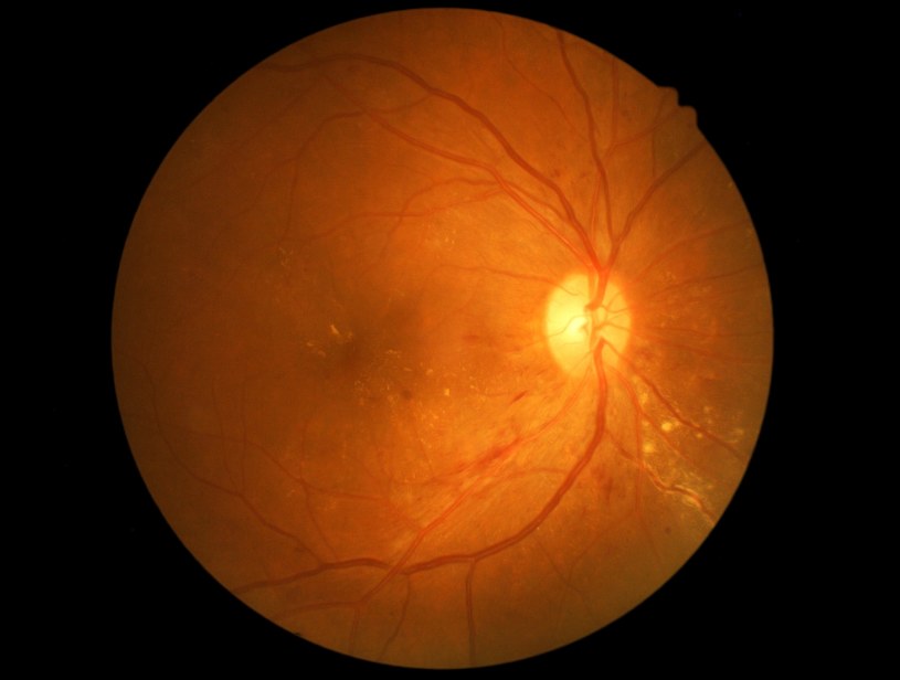 Tak wygląda dno oka osoby z cukrzycą - widać ślady retinopatii cukrzycowej. Na badanie dna oka może posłać cię też kardiolog /123RF/PICSEL